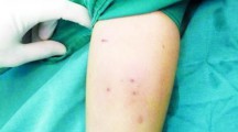 13岁女孩手臂扎进16根笔芯：为保持清醒做作业